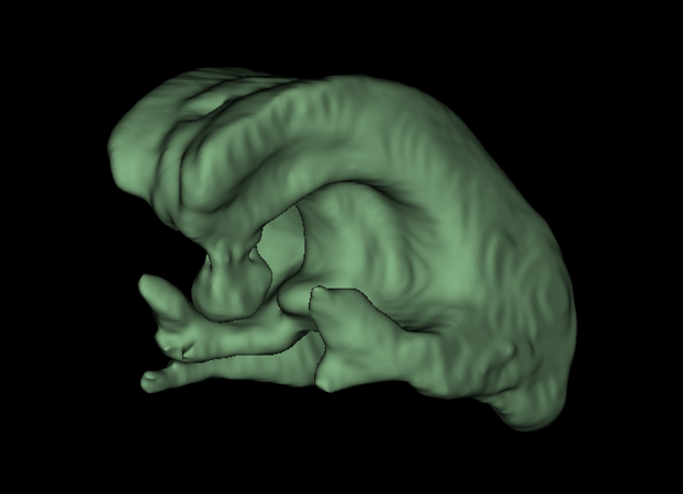 Deep Learning Cerebral Ventricle Segmentation